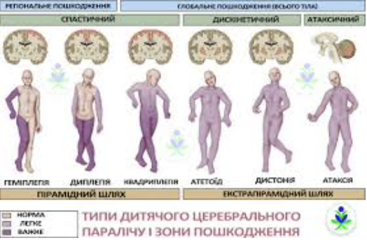 Атетоїдний ДЦП Кривий Ріг