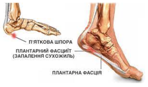 Плантарний фасциїт