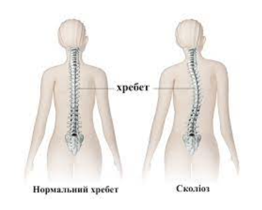 Сколіоз