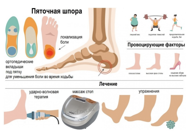 Лікування п’яткової шпори